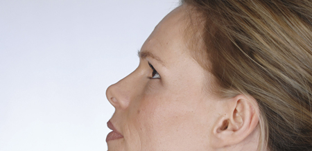Facelifting, Gesichtslifting, Stirnlifting SchlÃ¤fenlifting, Stirn Lift, SchlÃ¤fen Lifting