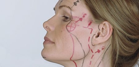 SchÃ¶nheitsoperation am Gesicht Facelift Facelifting Gesichtslifting